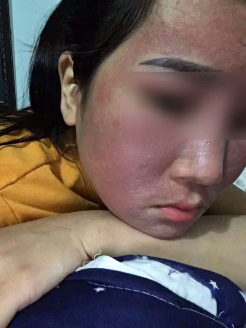 Kem trị mụn Ngọc Sâm bị ‘tố’ gây hỏng da khách hàng - Hình 2 Kem tri mun Ngoc Sam bi ‘to’ gay hong da khach hang-Hinh-2