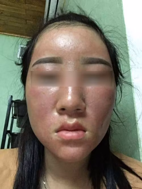 Kem trị mụn Ngọc Sâm bị ‘tố’ gây hỏng da khách hàng Kem tri mun Ngoc Sam bi ‘to’ gay hong da khach hang