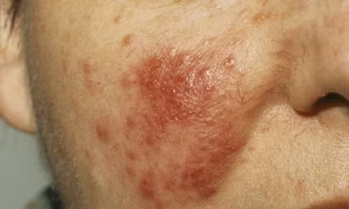 Nếu khuôn mặt luôn đỏ như đang xấu hổ về chuyện gì đó thì rất có thể bạn đã mắc bệnh rosacea. Ảnh minh họa.