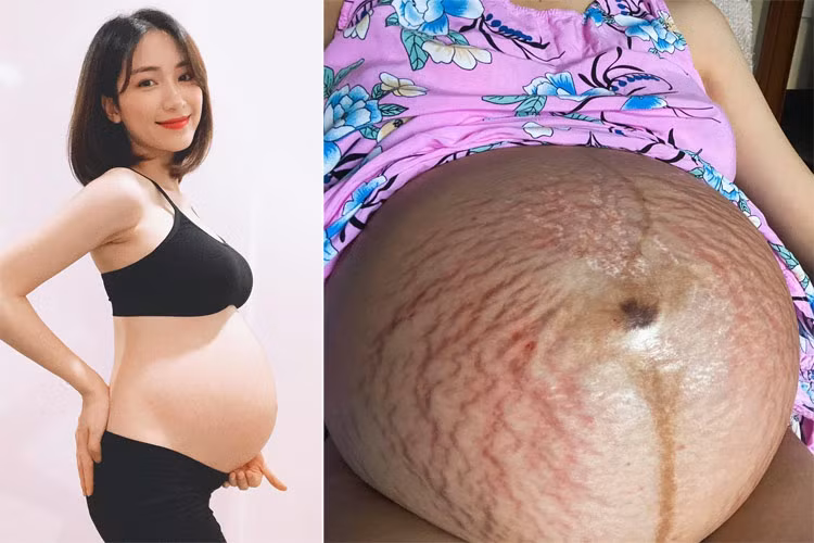 Hoà Minzy lúc mang bầu bé Bo 7 tháng, bụng chưa bị rạn (trái) và bụng khi sắp sinh được cô miêu tả trên trang cá nhân: "Cái bụng nặng trĩu như quả bóng nước".