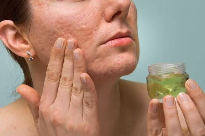 Xóa sạch sẹo mụn cứng đầu nhờ nguyên liệu dễ kiếm này - Hình 3 Xoa sach seo mun cung dau nho nguyen lieu de kiem nay-Hinh-3