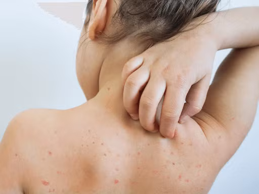Nhiều bệnh nhi nhập viện do mắc sởi Nhieu benh nhi nhap vien do mac soi