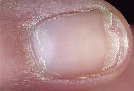 Nứt đầu ngón tay. Lớp biểu bì bị viêm là một dấu hiệu của sự thiếu hụt canxi và protein dẫn đến nứt đầu ngón tay. Ngoài ra, những vệt trắng ngang móng tay cũng là dấu hiệu bạn thiếu protein.