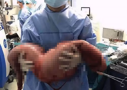 Suýt mất mạng vì táo bón kinh niên, ruột già chứa 13kg chất thải Suyt mat mang vi tao bon kinh nien, ruot gia chua 13kg chat thai