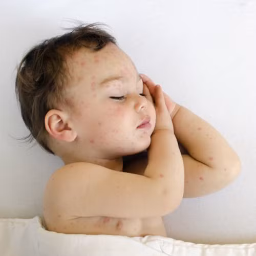  6. Tiêm phòng Hib. Vacxin Haemophilus cúm loại B là loại vi khuẩn gây bệnh viêm màng não - một loại bệnh thường thấy và đặc biệt nguy hiểm cho trẻ dưới 5 tuổi. Trước năm 1987, bệnh Hib cướp đi sinh mạng của 400 trẻ em Mỹ mỗi năm. Ngày nay, nhờ có tiêm phòng hib, con số đã giảm xuống chỉ còn 50 trường hợp mỗi năm. Nên tiêm vacxin Hib khi trẻ được 2 tháng tuổi, 4 tháng tuổi, 6 tháng tuổi và 12 - 15 tháng tuổi. 