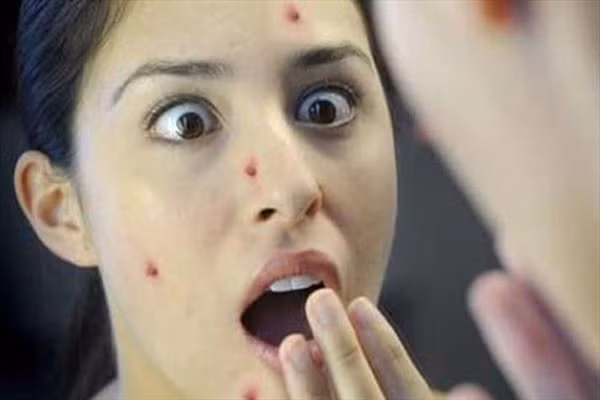  7. Phản ứng của da. Lỗ chân lông trên da được kết nối với tuyến dầu dưới da thông nang. Nếu quá nhiều độc tố thì chất độc, bã nhờn sẽ đi qua nang bài tiết ra lỗ chân lông. Độc tố và vi khuẩn xâm nhập từ bên ngoài cùng tế bào da chết sẽ góp phần bít những nang này lại. Khi nang của tuyến da bị bít lại, mụn sẽ mọc lên. 