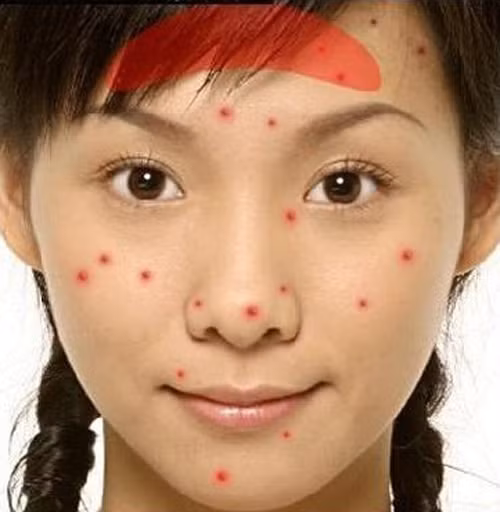  Mụn mọc ở trán dọc đường chân tóc. Thường gây ra bởi các sản phẩm làm đẹp như trang điểm hay dầu gội là bít lỗ chân lông của mái. Cũng có thể, do mái tóc của bạn quá nhờn. Để tránh điều này, hãy làm sạch lớp trang điểm trước khi đi ngủ, tẩy tế bào chết mỗi tuần và gội đầu thật sạch sẽ. Nếu đám mụn mọc lên trở thành vấn đề nghiêm trọng, hãy dùng nước hoa hồng hằng ngày xung quanh vùng chân tóc.
