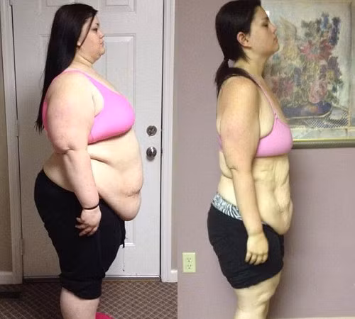 Cô từng mặc quần cỡ 32 và áo cỡ 4XL. Sau khi giảm cân nhiều, Kaitlyn Smith tiếp tục bị đè nặng bởi phần da thừa trên cơ thể.