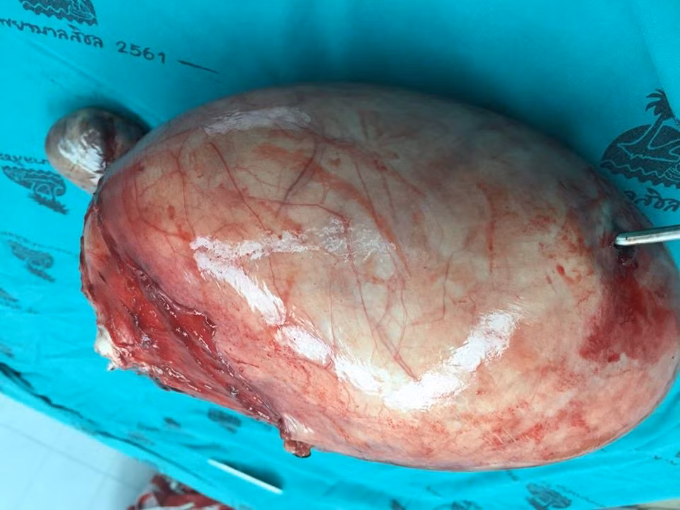 Bệnh nhân sưng đau bụng lâu ngày khiến bác sĩ tá hỏa vì điều khủng khiếp Benh nhan sung dau bung lau ngay khien bac si ta hoa vi dieu khung khiep