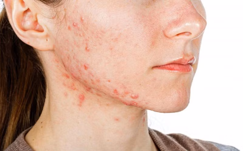 Gây mụn: Điện thoại bẩn có thể gây ra mụn trên da đặc biệt là da vùng mặt. Để phòng tránh, bạn có thể sử dụng tai nghe hoặc loa ngoài thay vì áp điện thoại trực tiếp lên da mặt.