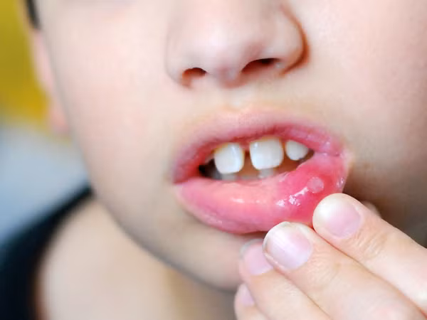 Chữa hết nhiệt miệng: củ cải trắng ép lấy nước cốt. Súc miệng nhiều lần/ ngày với nước cốt củ cải sẽ khiến bệnh nhiệt miệng nhanh khỏi. Ảnh: marrybaby