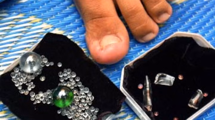 1 . Ngón chân “nhả ngọc”: Sau một cơn sốt, cô gái Siti Suhana Saadon 23 tuổi, sống tại thị trấn Durian Tunggal ở Malaysia, bỗng thấy dưới những móng chân mình xuất hiện hiện tượng lạ.