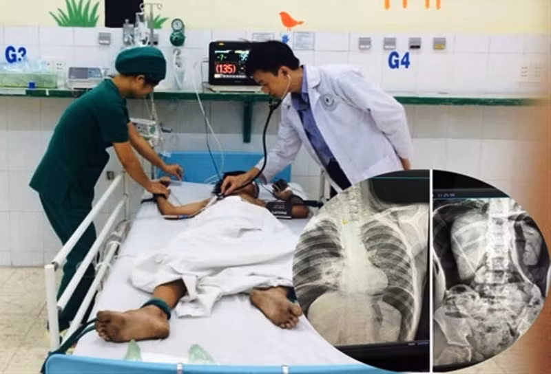 Be trai vo dai trang, nguy kich vi ban bom hoi vao hau mon