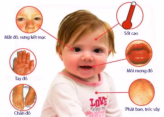 Trẻ ho sốt đừng coi thường dấu hiệu bệnh lạ nguy hiểm Kawasaki Tre ho sot dung coi thuong dau hieu benh la nguy hiem Kawasaki