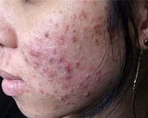 Mặt nữ sinh chi chít mụn vì dùng mỹ phẩm "thần thánh" làm đẹp đón Tết Mat nu sinh chi chit mun vi dung my pham