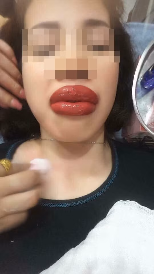 Thành quả của một cô nàng sau khi phun môi xong là đây. Ảnh: Tổng hợp
