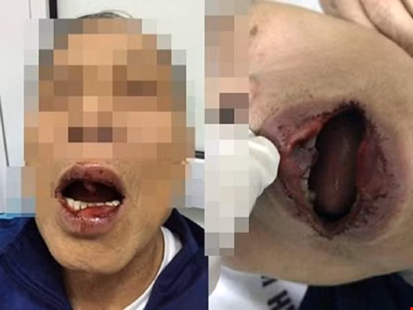 Hình ảnh tiến sỹ Khanh bị cán bộ Sở Ngoại vụ hành hung phải nhập viện trước đó.