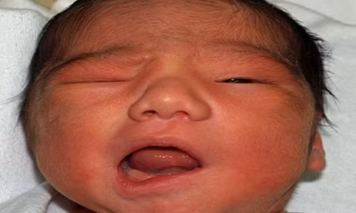 Nguyên nhân bất ngờ khiến trẻ em bị méo miệng mùa đông Nguyen nhan bat ngo khien tre em bi meo mieng mua dong
