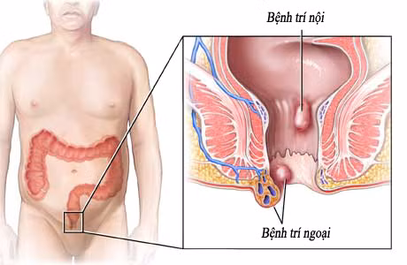 Bài thuốc này được đánh giá khá hiệu quả trong việc chữa bệnh trĩ. Bạn chỉ cần thực hiện liên tiếp 15 ngày các triệu chứng của bệnh giảm đáng kể.