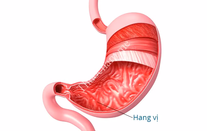 Xuất huyết dạ dày cũng có thể gặp trên bệnh nhân có bệnh lý tăng áp lực tĩnh mạch cửa do xơ gan, ung thư dạ dày.