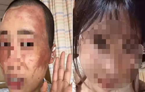 Khong chiu sinh con thu 2, vo bi chong tat axit