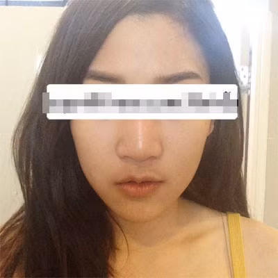 Được biết để giữ cho khuôn mặt không bị sẹo, Pamp buộc phải sử dụng một số kháng chất, áp dụng một số liệu pháp riêng biệt do các bác sĩ phẫu thuật đề ra. Trong bức ảnh này, phải thật tập trung, căng mắt ra nhìn người xem mới có thể nhận ra hai vết hằn nhỏ, rất mờ bên hai má của Pamp.