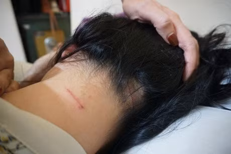 Qua giám định, chị Trang có kết quả đa chấn thương, chấn động não, tổn hại sức khỏe 12%.