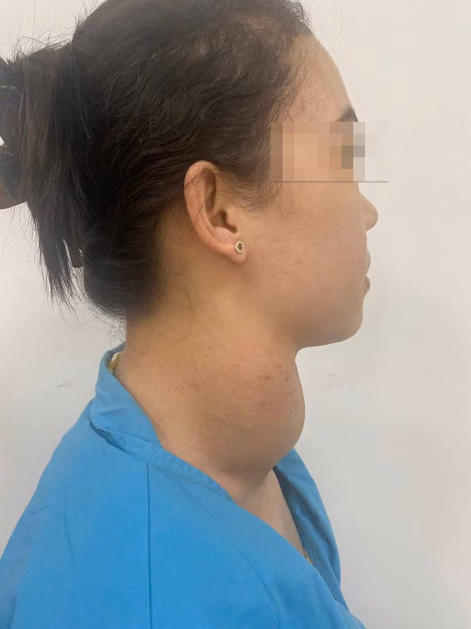 Cắt bướu giáp khổng lồ cho bệnh nhân mắc basedow 12 năm Cat buou giap khong lo cho benh nhan mac basedow 12 nam