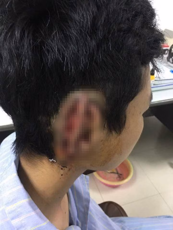Hy hữu: Nối lại tai cho nam sinh bị bạn cắn đứt rồi nuốt vào bụng Hy huu: Noi lai tai cho nam sinh bi ban can dut roi nuot vao bung
