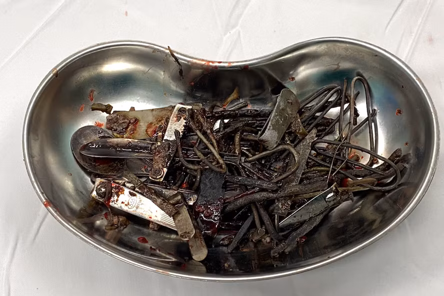 Ăn 1 kg đinh, sắt, lưỡi dao... người đàn ông tổn thương dạ dày nặng An 1 kg dinh, sat, luoi dao... nguoi dan ong ton thuong da day nang