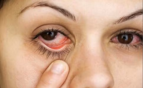 Trong một số trường hợp mắt đỏ có thể là do một mao mạch nhỏ ở gần mắt bị đứt mà gây ra hiện tượng này. Những triệu chứng thường gặp như mắt đỏ ngàu, ngứa ngáy trong mắt.