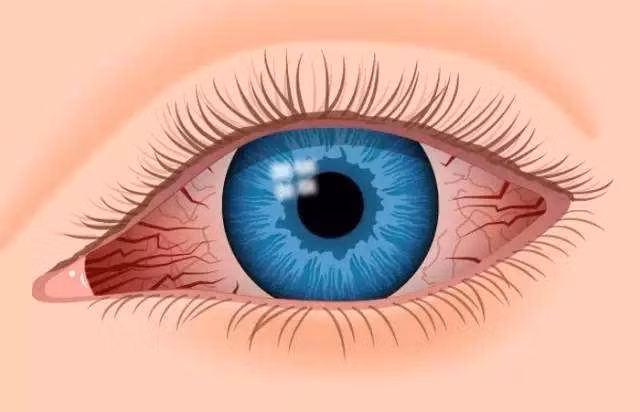 Tuy diễn biến của bệnh chậm nhưng nguy hiểm tương đối lớn, nếu không kip thời phát hiện và điều trị sẽ có thể gây mù mắt.