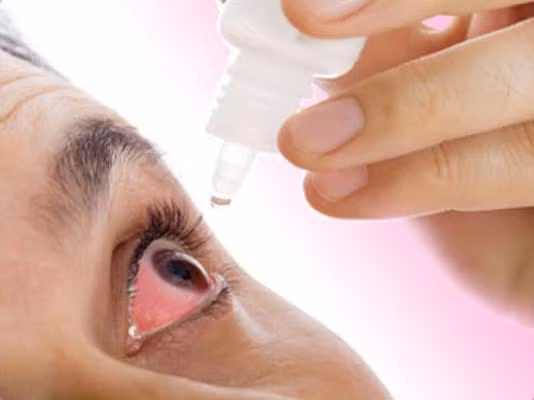 Mắt khô hay còn gọi là khô kết mạc, bệnh này cũng gây ra hiện tượng mắt đỏ.