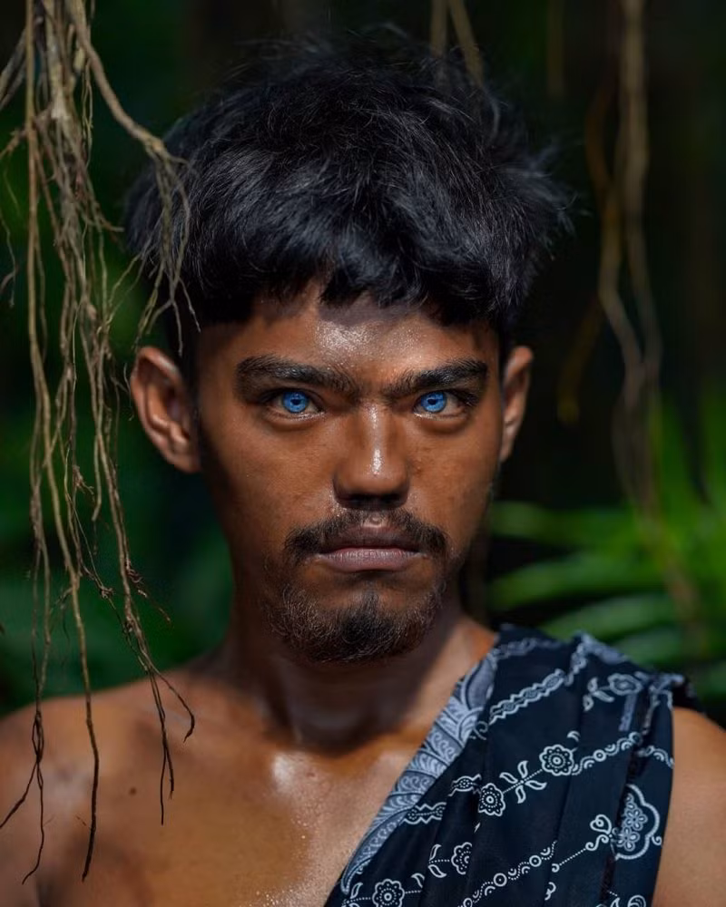 Những người mắc hội chứng Waardenburg thường sở hữu đôi mắt xanh nhạt hoặc có hai màu khác nhau ví dụ như một mắt màu nâu và mắt còn lại màu xanh.