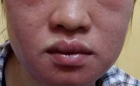 Mặt “biến dạng” vì thần dược siêu trắng da Mat “bien dang” vi than duoc sieu trang da