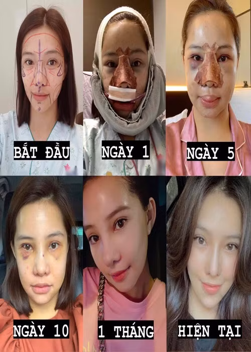 Lưu Đê Ly công khai ảnh “đập mặt xây lại”, soi nhan sắc hiện tại Luu De Ly cong khai anh “dap mat xay lai”, soi nhan sac hien tai