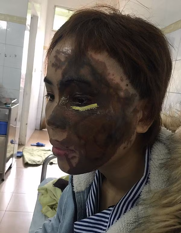 Hành trình hồi sinh gương mặt cho cô gái bị thiếu úy tạt axit - Hình 2 Hanh trinh hoi sinh guong mat cho co gai bi thieu uy tat axit-Hinh-2