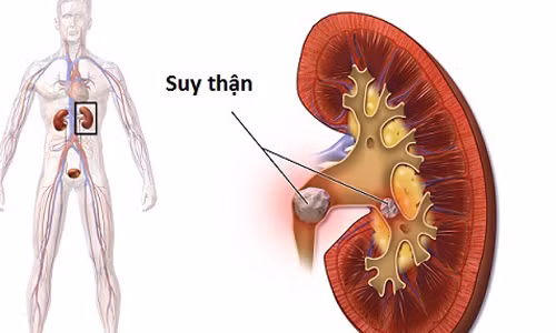 Các vấn đề về thận được xem là một trong những "sát thủ thầm lặng" đe dọa sức khỏe. Hầu hết bệnh nhân bị suy giảm chức năng thận thường không có dấu hiệu bệnh thận trong giai đoạn đầu. Tuy nhiên, chức năng thận không làm việc đúng cách sẽ khiến độc tố tích tụ trong cơ thể.