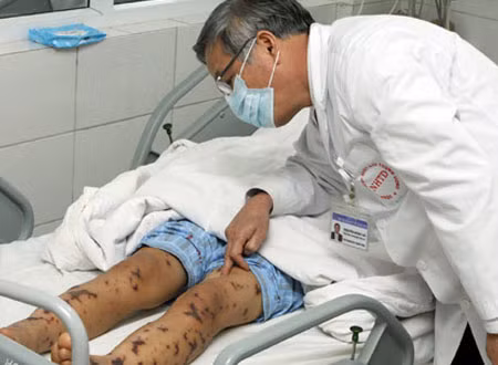Nhiễm liên cầu khuẩn do ăn uống mất vệ sinh, ăn đồ sống. Thời điểm này, dịch bệnh liên cầu khuẩn heo dễ phát tán bởi người dân ăn tiệc tùng dễ ăn phải heo bẩn mang mầm bệnh. Người bị bệnh liên cầu khuẩn từ heo thường mắc ở hai thể. Ở thể cấp tính, bệnh nhân bị sốc nhiễm trùng huyết khiến người bệnh sốt cao, tụt huyết áp, sốc, gây suy đa phủ tạng, xuất huyết và hoại tử toàn thân…, dẫn đến tử vong rất nhanh.
