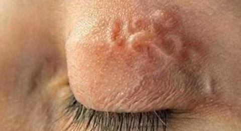 Mắc bệnh sán vô cùng nguy hiểm nếu không được điều trị kịp thời. Bởi khi trẻ mắc các giun tóc, giun móc bám vào niêm mạc ruột gây viêm loét ruột, thậm chí gây chảy máu rỉ rả, nhiều trẻ bị thiếu máu có khi phải truyền máu. Nếu bị nhiễm giun đũa có thể gây tắc ruột, tắc mật, tắc ống tụy gây ra các triệu chứng đau bụng dai dẳng hoặc kịch phát, ói mửa, vàng da, viêm gan…Ảnh: Zing.