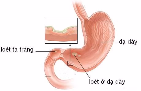 Thường xuyên uống nước chanh khi đói (dù là pha với đường hay với mật ong) sẽ ảnh hưởng không tốt đến dạ dày như khiến dạ dày bạn bị ăn mòn bởi axit, gây ra viêm, loét, thậm chí xuất huyết bao tử. Đặc biệt, vấn đề này sẽ trở nên nghiêm trọng hơn nếu dạ dày bạn đã “có bệnh” sẵn.