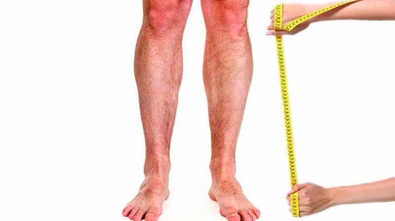 Kéo dài chi là một phẫu thuật lớn, cần thiết bị đầy đủ, cần kinh nghiệm. Do đó cần chú ý các yếu tố đó trong kéo dài chi. Kéo dài chi là tạo sự đẹp với chức năng tốt mà tất cả sự tốt đẹp nào cũng cần phải có công phu và khó nhọc. Do đó người bệnh và bác sĩ cũng phải trả giá cho cái đẹp này. Người bệnh phải chịu cuộc mổ, chịu đau, chịu căng thẳng và người bác sĩ phải có công theo dõi cẩn thận. (Ảnh: wiseGEEK, Global News, Benhvien108, heightsurgery.com)