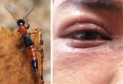 Mắt sưng đỏ, ngứa rát vì dính dịch của kiến ba khoang Mat sung do, ngua rat vi dinh dich cua kien ba khoang