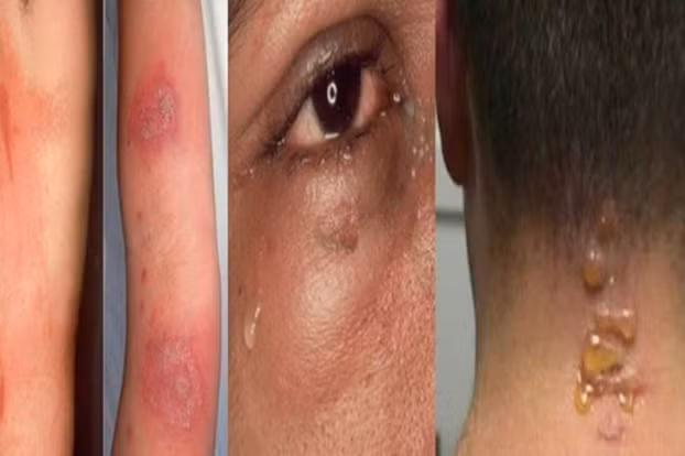 Mắt sưng đỏ, ngứa rát vì dính dịch của kiến ba khoang - Hình 2 Mat sung do, ngua rat vi dinh dich cua kien ba khoang-Hinh-2
