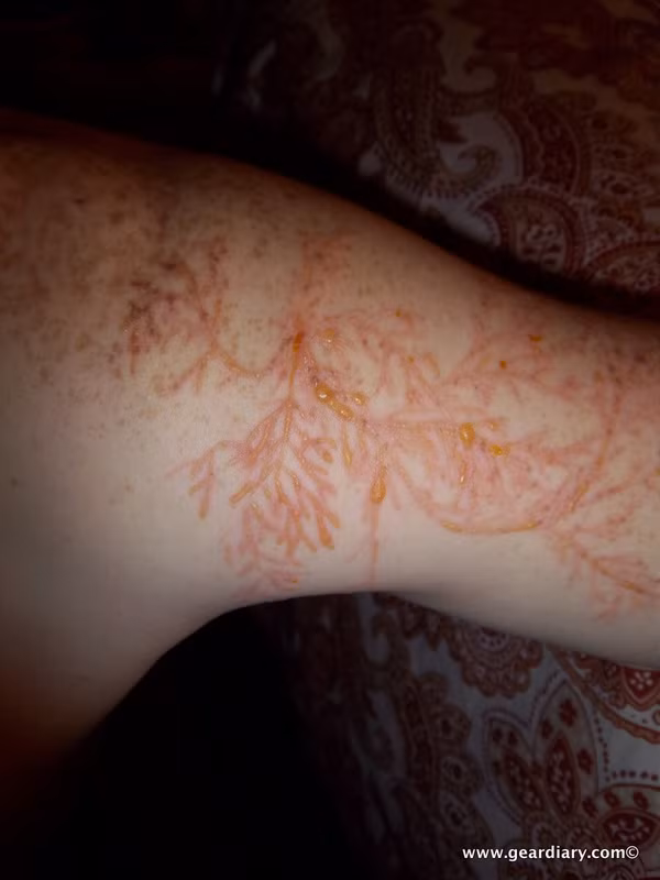 Những người sau khi bị sét đánh trúng thì trên cơ thể sẽ xuất hiện "hoa sét" (Lichtenberg figures) với vệt đỏ hình hoa dương xỉ.