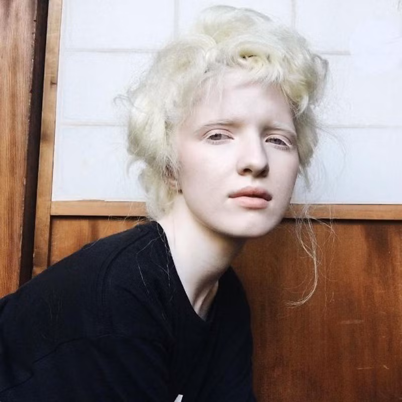 Nastya Zhidkova được mệnh danh là cô gái bạch tạng đẹp nhất thế giới. Cô sinh năm 1996, ở Nga. Cô hiện là người mẫu nổi tiếng và cũng là một ca sĩ tài năng.