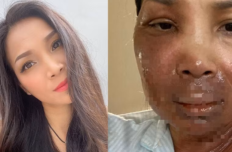 Tối 23/5, trên trang cá nhân, Hồng Ngọc đăng bức ảnh cô bị bỏng hơn nửa khuôn mặt do nồi xông hơi, khiến ai nhìn thấy cũng xót xa.