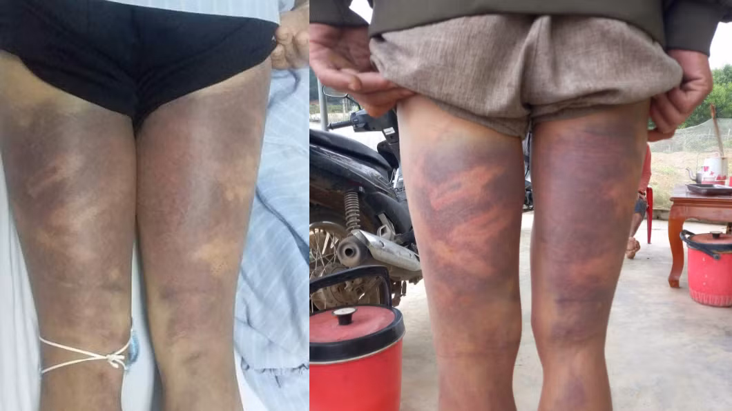  Một người dân nhập viện sau khi về từ trụ sở Công an xã: Ngày 21/3, UBND tỉnh Nghệ An cho biết, UBND tỉnh này vừa nhận được đơn của bà Nguyễn Thị Thạnh (ngụ xã Hiến Sơn, huyện Đô Lương) tố cáo ông Phạm Văn Quân - Công an viên và ông Phạm Văn Ngọc - Phó Công an xã Hiến Sơn có hành vi đánh người trái quy định pháp luật. 