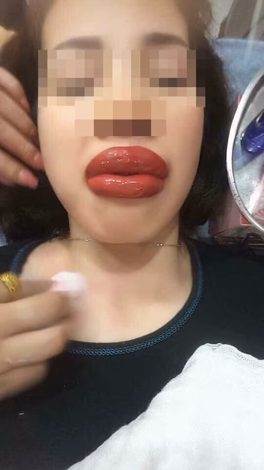 Đôi môi của cô gái này sau khi xăm xong cũng không khá hơn là bao. Ảnh: Tổng hợp