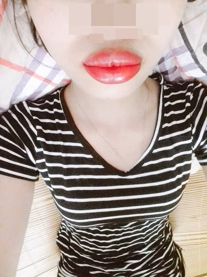 Hình ảnh đôi môi sưng vù khiến hội chị em ám ảnh.